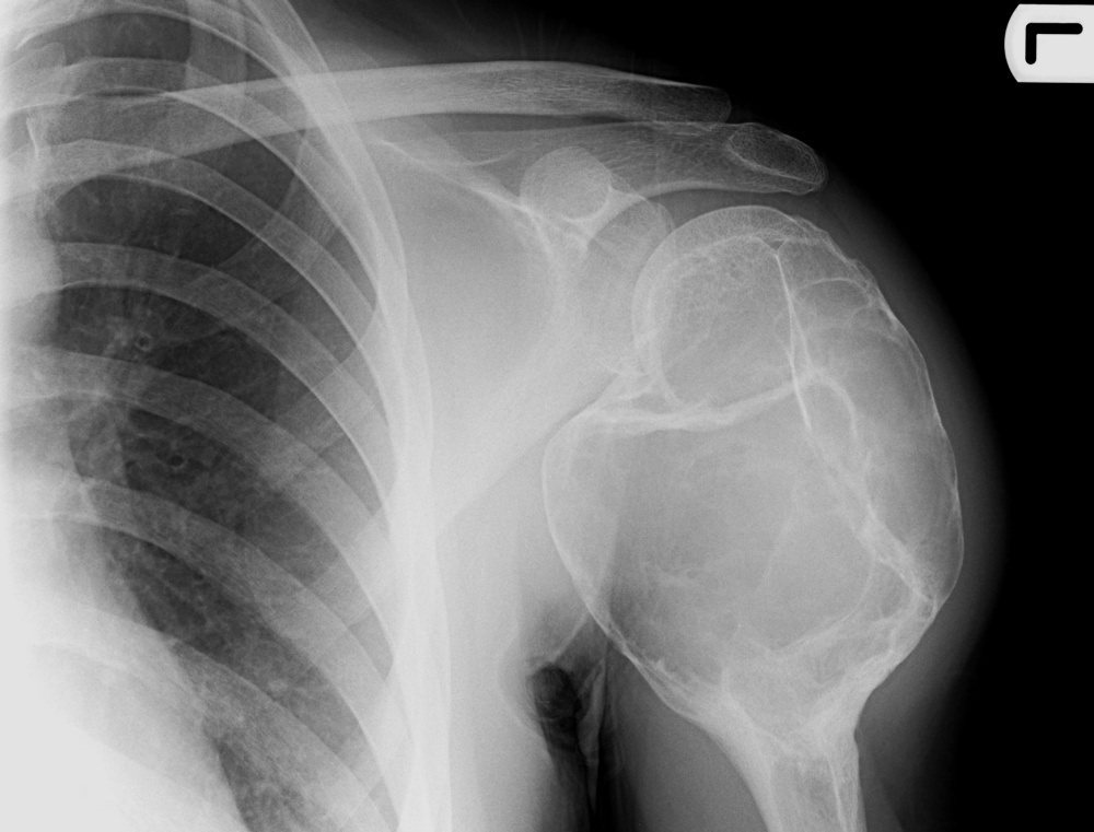 Bone Tumours And Benign Lytic Lesions